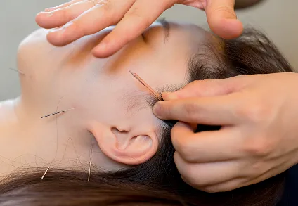 美容鍼