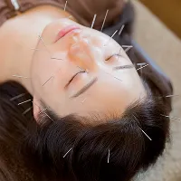 美容鍼